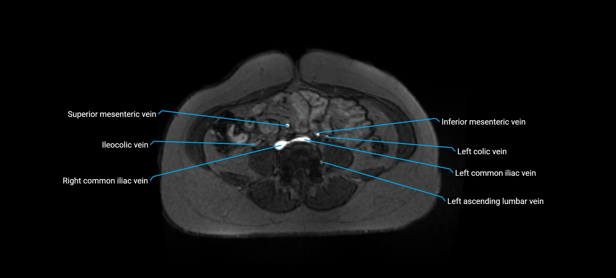 MRV abdomen pelvis & lower limb axial cross sectional anatomy labelled MRI image 116 (1).webp